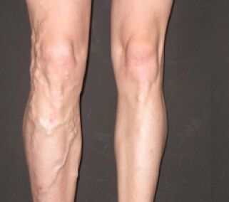 As varices son rápidas