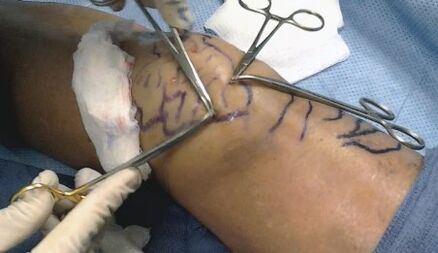 Operación para varices