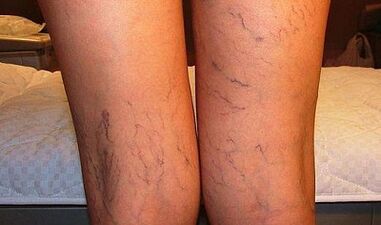 Síntomas de varices nas mulleres