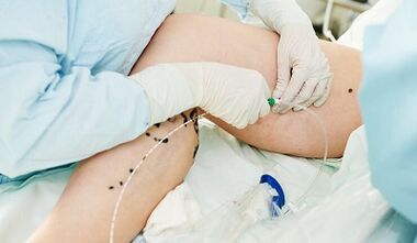 Métodos para o tratamento das varices nas pernas das mulleres