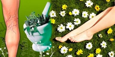 Tratamento de varices con remedios populares