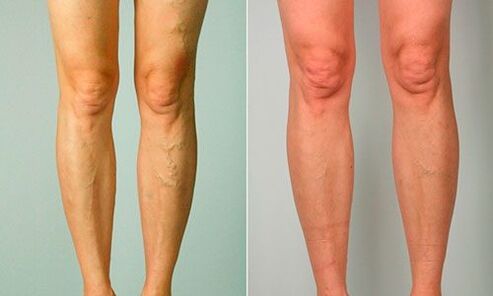 antes e despois do tratamento de varices