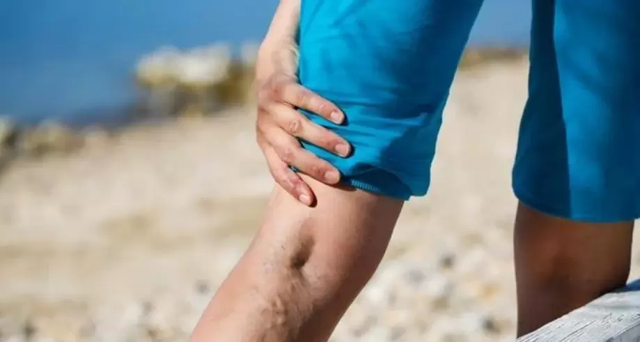 Varices nas pernas