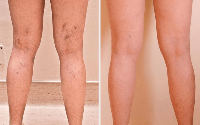 Pernas antes e despois do tratamento de varices