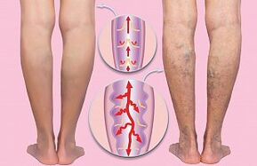 Varices das extremidades inferiores