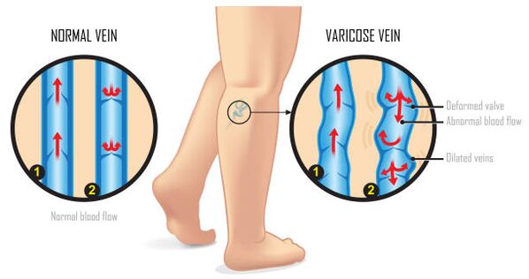 Varices das extremidades inferiores