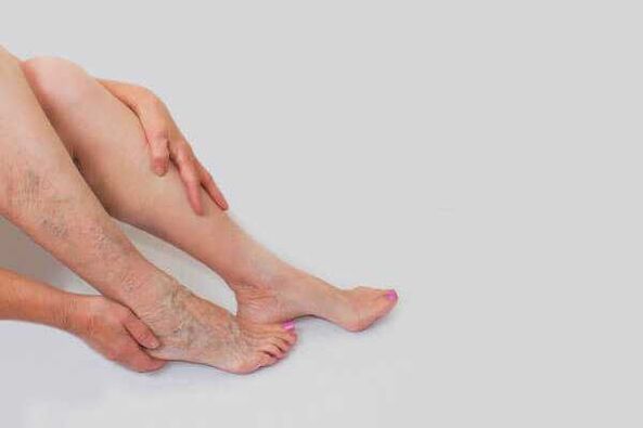 As veas dilatadas que sobresaen son un sinal de varices nas extremidades inferiores