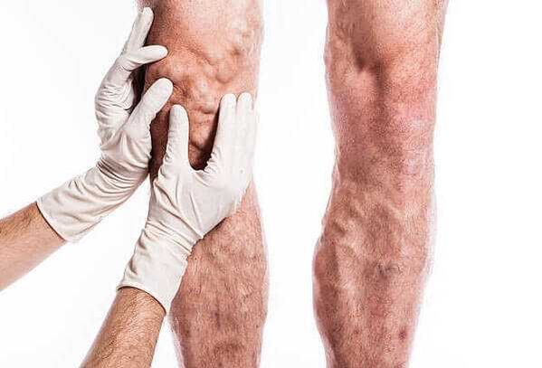 Palpación de varices nas pernas