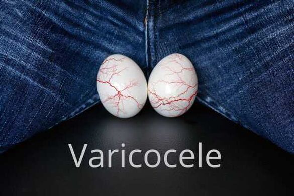 Varicocele agrandamento das veas do cordón espermático