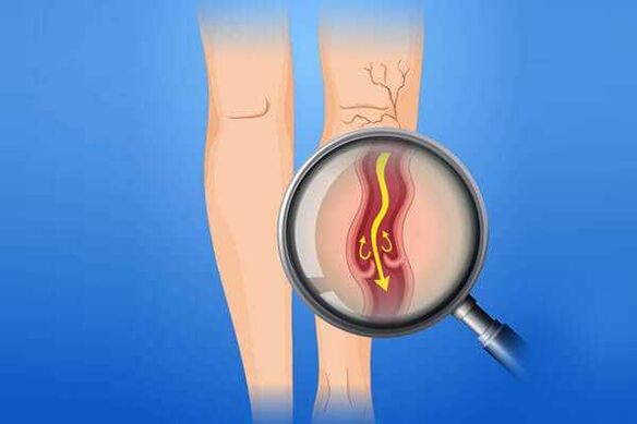 Válvula venosa afectada por varices